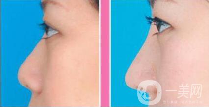 耳軟骨隆鼻多少錢