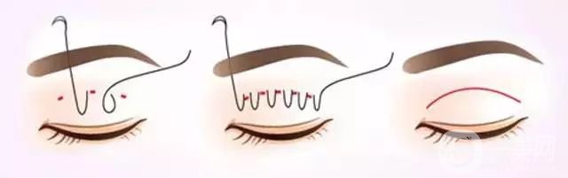 什么叫埋線雙眼皮 埋線雙眼皮怎么樣？