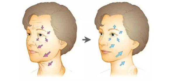 玻尿酸去法令紋的價錢 時間保持久嗎？