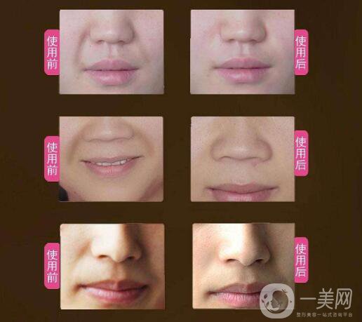 玻尿酸去法令紋的價錢 時間保持久嗎？