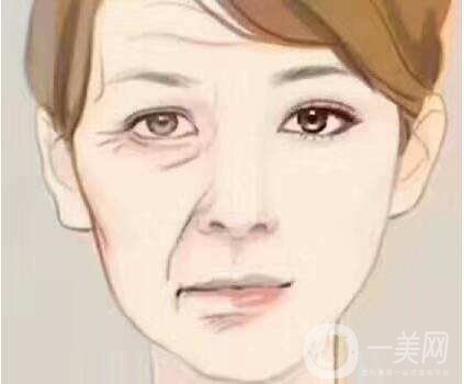 玻尿酸去法令紋價格是多少 去法令紋方法