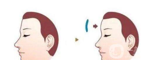 硅膠豐額頭貴嗎 硅膠豐額頭材料有哪些？