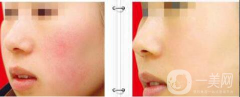 光子嫩膚,價(jià)錢