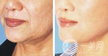 拉皮多少錢,拉皮除皺價格