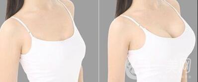 假體豐胸手術(shù)費(fèi)用,假體豐胸多少錢(qián)