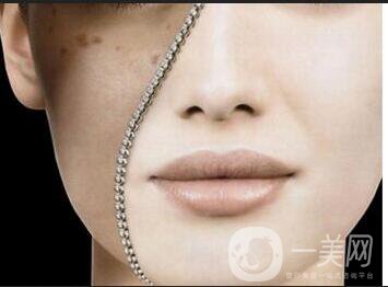 激光祛除黃褐斑*果,激光祛除黃褐斑注意事項(xiàng)