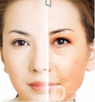 prt是什么 是電波拉皮嗎？