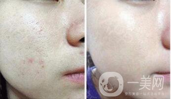 果酸換膚后注意事項(xiàng) 果酸換膚手術(shù)*果如何
