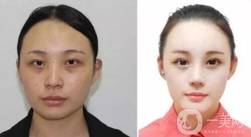 光子嫩膚的優(yōu)勢 光子嫩膚有風(fēng)險嗎？