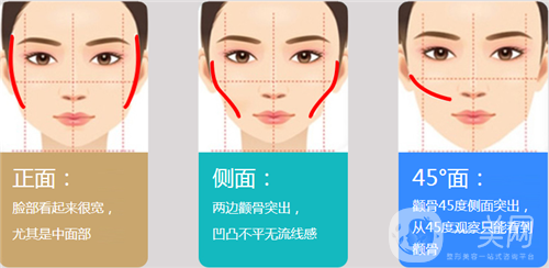 磨顴骨前后圖 磨顴骨多少錢