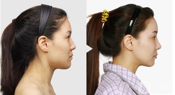 墊下巴前后圖 墊下巴的方法有哪些