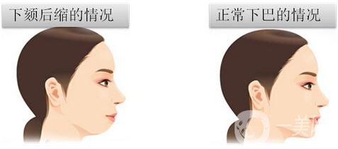 墊下巴前后圖 墊下巴的方法有哪些