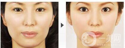 磨下頜角價格是多少呢 下頜角整形價格介紹一覽