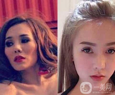 女子被前男友嫌丑 怒花12萬(wàn)整容成美女