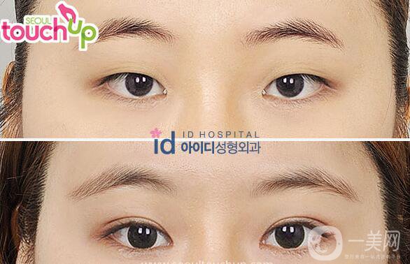 雙眼皮手術(shù)大解讀！