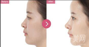 *隆鼻價(jià)格,*隆鼻*果