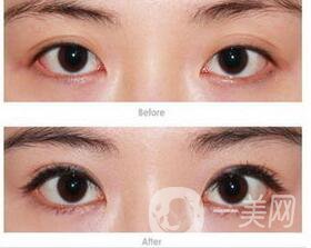 韓式開眼角,韓式開眼角*果,韓式開眼角注意事項