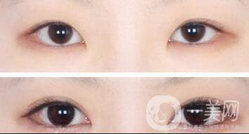 開(kāi)眼角*果,開(kāi)眼角需要注意什么