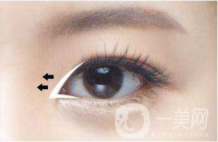 雙眼皮開眼角*嗎 開眼角要恢復(fù)多久