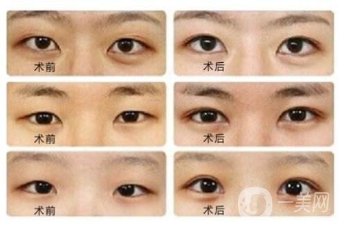 雙眼皮開眼角*嗎 開眼角要恢復(fù)多久