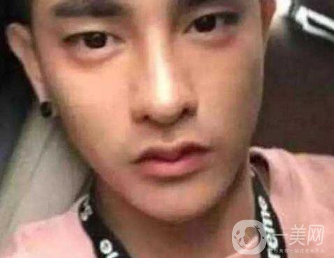 小伙整容數(shù)十次，只為一張韓星臉