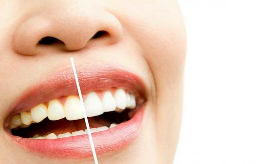 激光牙齒美白真的*嗎？