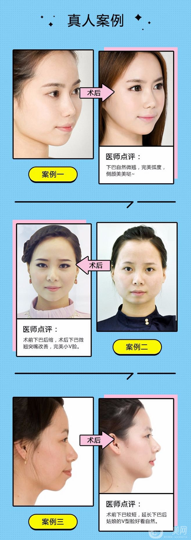 墊下巴都有哪些方式呢？墊下巴前后圖