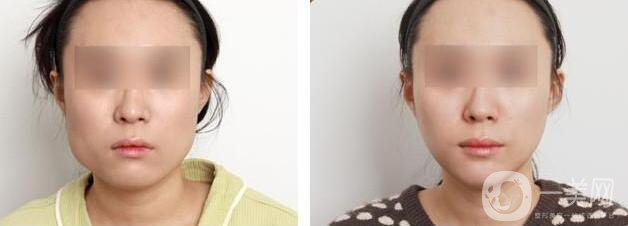 墊下巴什么材料好 注射玻尿酸的方法