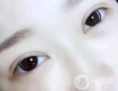 生物焊接雙眼皮手術(shù) 割雙眼皮的方法