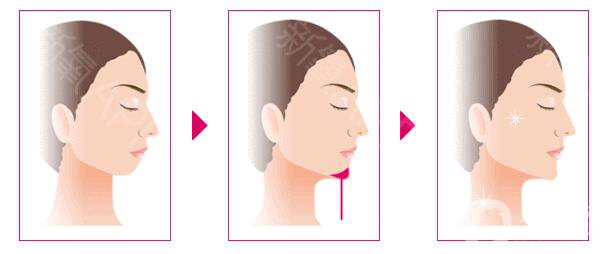 墊下巴多長時間恢復 墊下巴后怎么護理