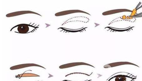 焊接雙眼皮怎么樣 焊接雙眼皮手術(shù)*果怎么樣