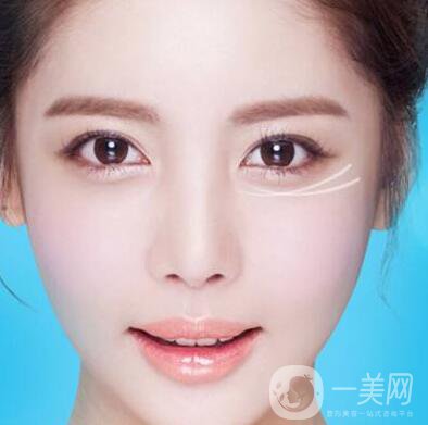 注射去皺后時間久了皺紋會變得更糟嗎？