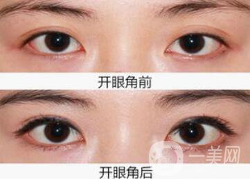 開(kāi)眼角注意事項(xiàng),開(kāi)眼角