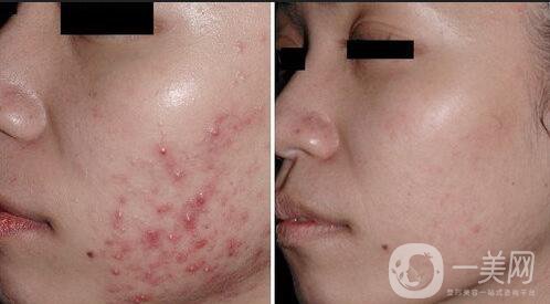 果酸換膚副作用