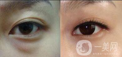 超聲去眼袋多少錢,超聲去眼袋*果