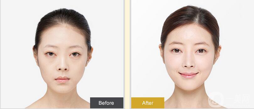 開內(nèi)外眼角*果如何？開眼角前后照片