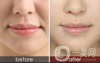 去法令紋,去法令紋注意事項(xiàng)