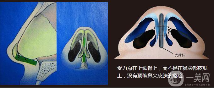 醫(yī)生測評：自體隆鼻專家 張笑天