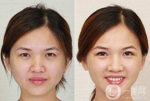 **價格 *瘦臉有副作用嗎