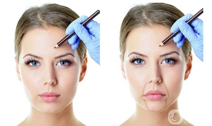 去法令紋多少錢 去法令紋的手術(shù)方法