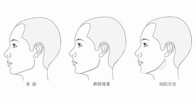 削骨手術(shù)危險(xiǎn)嗎 削骨手術(shù)*果怎么樣