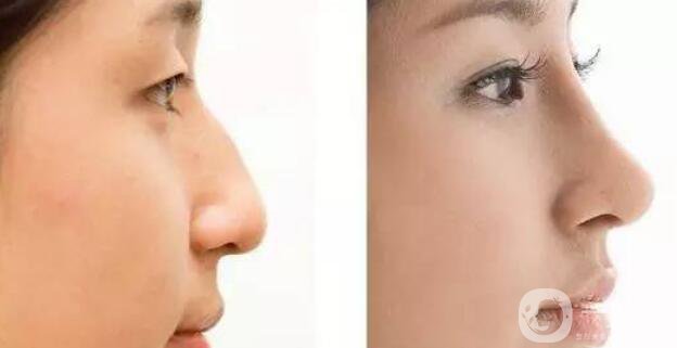 墊鼻梁危害,墊鼻梁術(shù)后護(hù)理方式