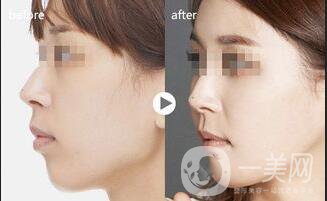 鼻部鼻尖整形多久恢復(fù)