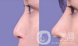 鼻骨矯正多久恢復(fù),鼻骨矯正術(shù)后護(hù)理