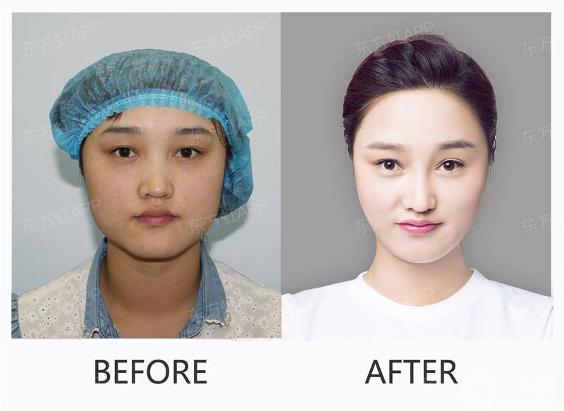 光子嫩膚的注意事項 光子嫩膚*果怎么樣