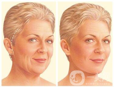 韓國(guó)吸血鬼面部提升術(shù)是什么？它有什么不同？