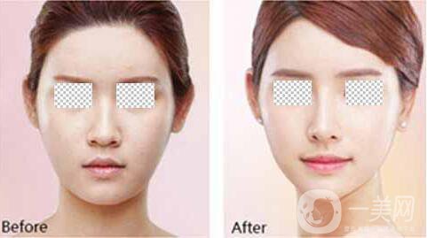 深圳假體豐眉弓手術費用 眉弓手術*嗎