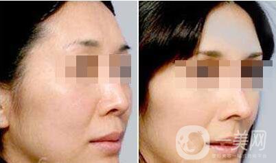 北京自體脂肪豐眉弓多少錢 *果怎么樣？