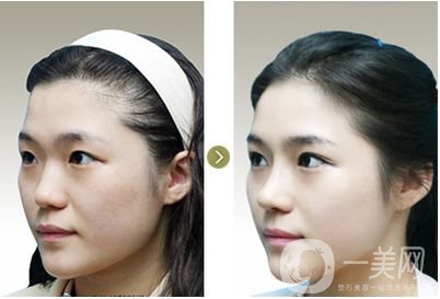 深圳微整形鼻子價(jià)格是多少 隆鼻方式有哪些