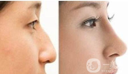 廣東耳軟骨墊鼻子要多少錢 墊鼻子有風險嗎